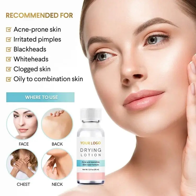 treatments acne (II)